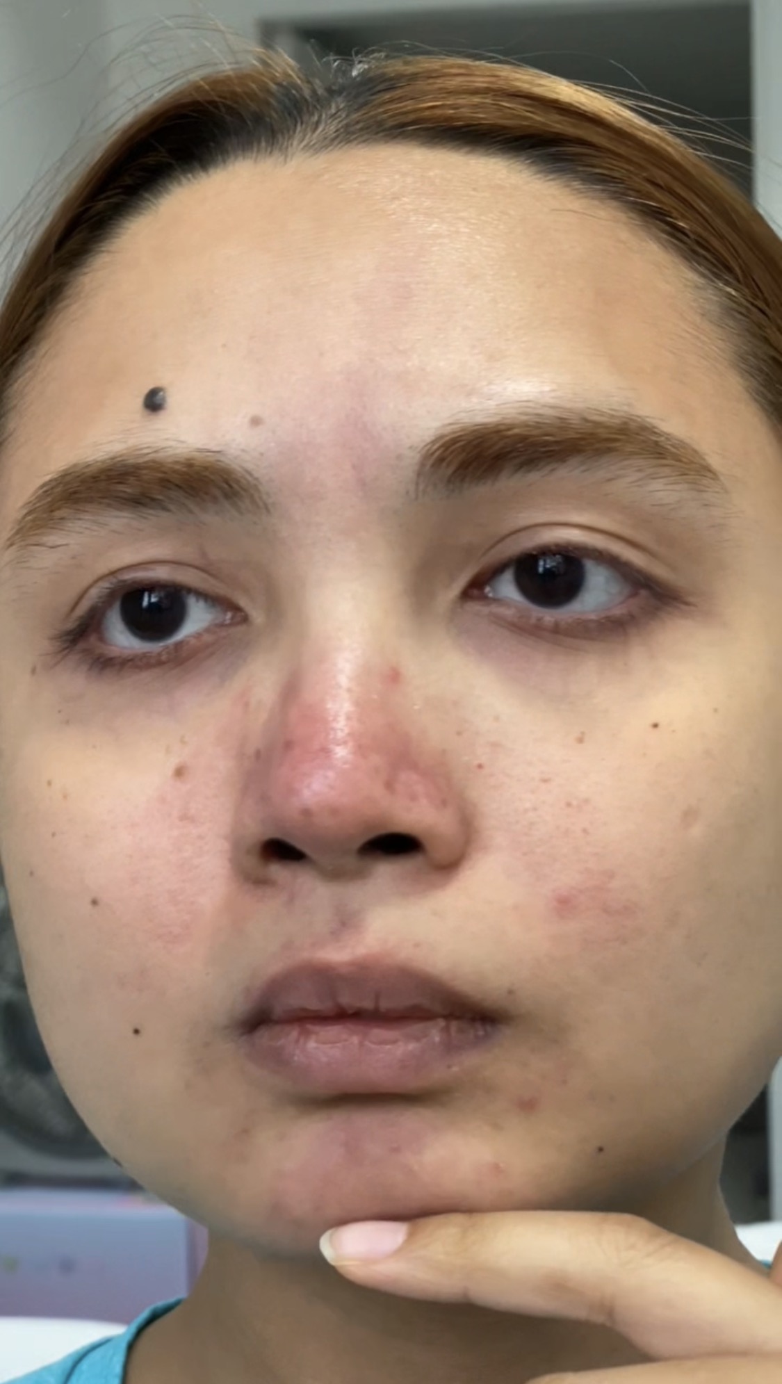 Woman showing skin imperfections close-up